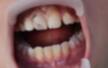 10个月宝宝门牙缝隙大怎么办