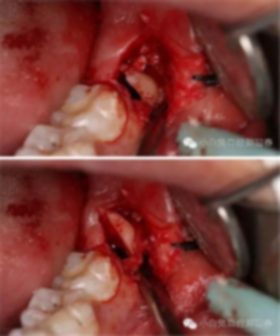 拔牙过程图解视频