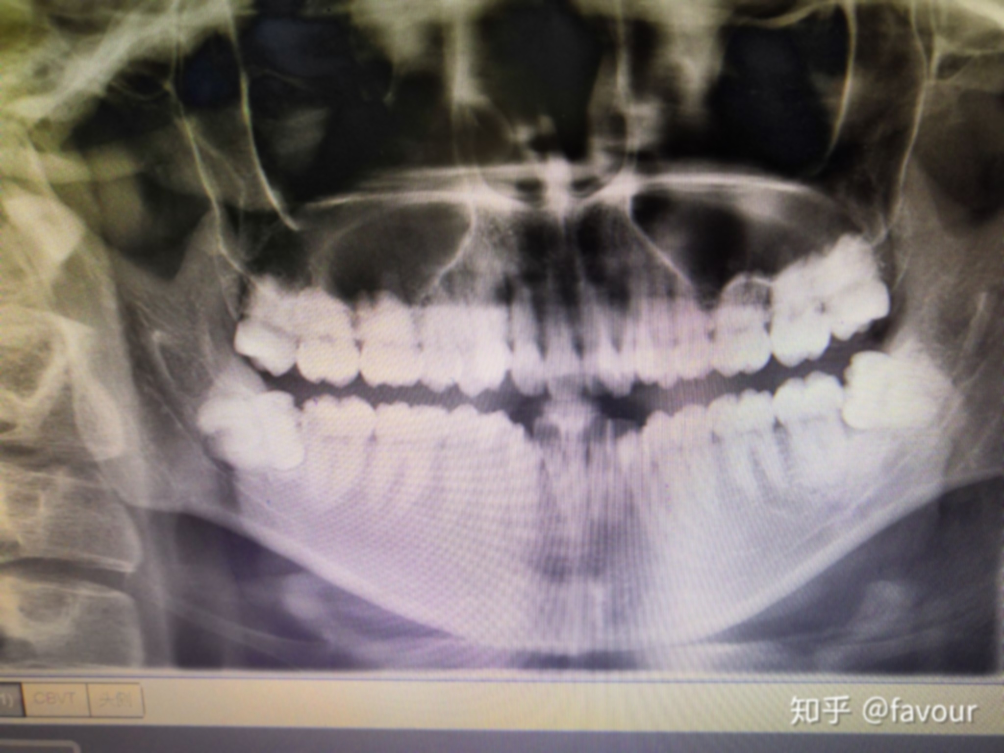 拔智齿第三天是高峰期怎么办