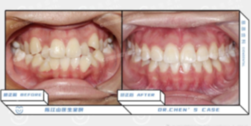 拔牙矫正后嘴还是突出