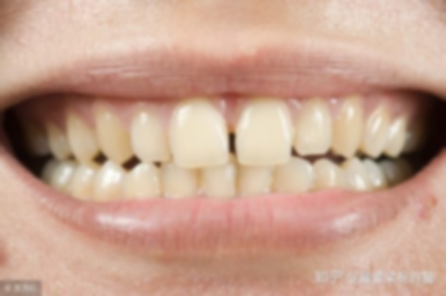 34岁矫正牙齿需要多长时间